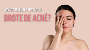 prevenir un brote de acne